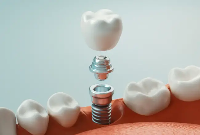 5 fontos érv a fogászati implantátum mellett