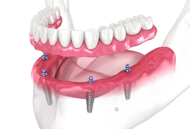 A fogászati implantáció nemcsak egyetlen fog pótlására alkalmas!