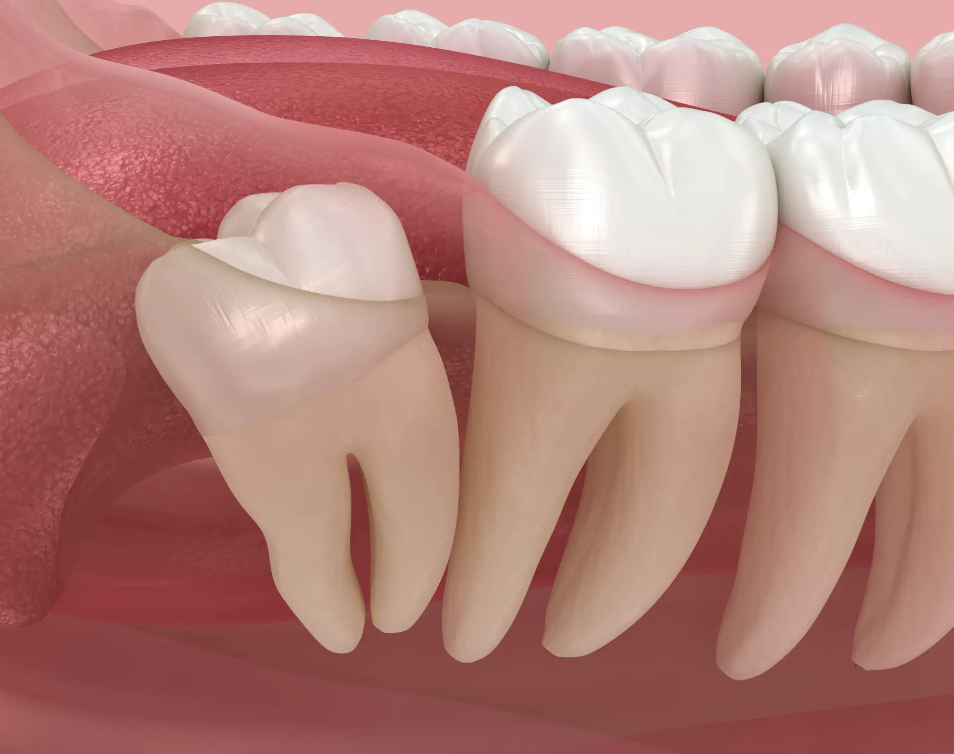 A bölcsességfog eltávolítása folyamatos gyulladásoktól kímélhet meg!