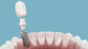 fogászati implantátum