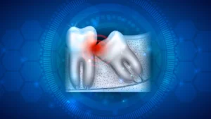 bölcsességfog eltávolítás után