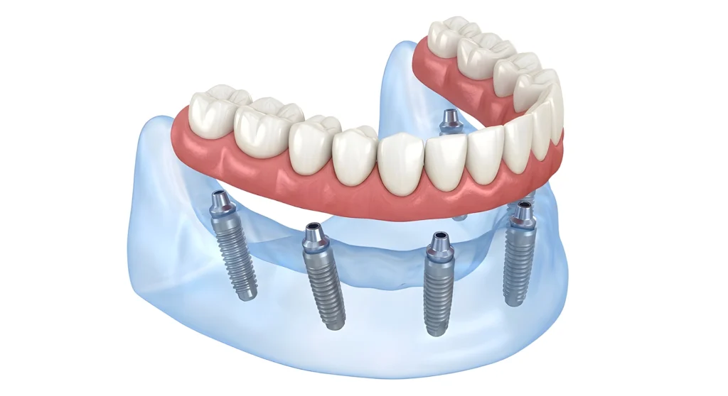 all on 4 implantátum